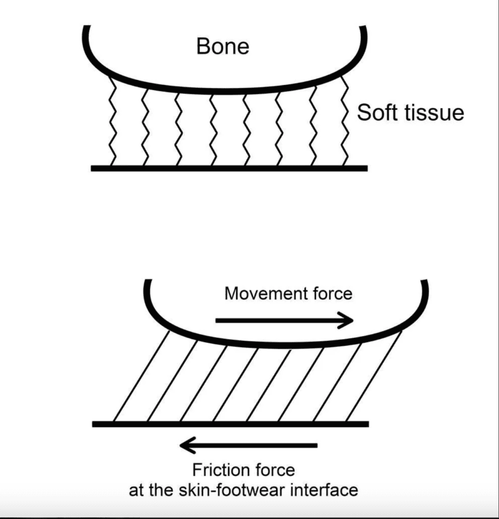 diagram showing shear distortion between bone, soft tissue and skin 